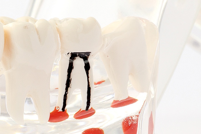 重度の虫歯を治す「根管治療」